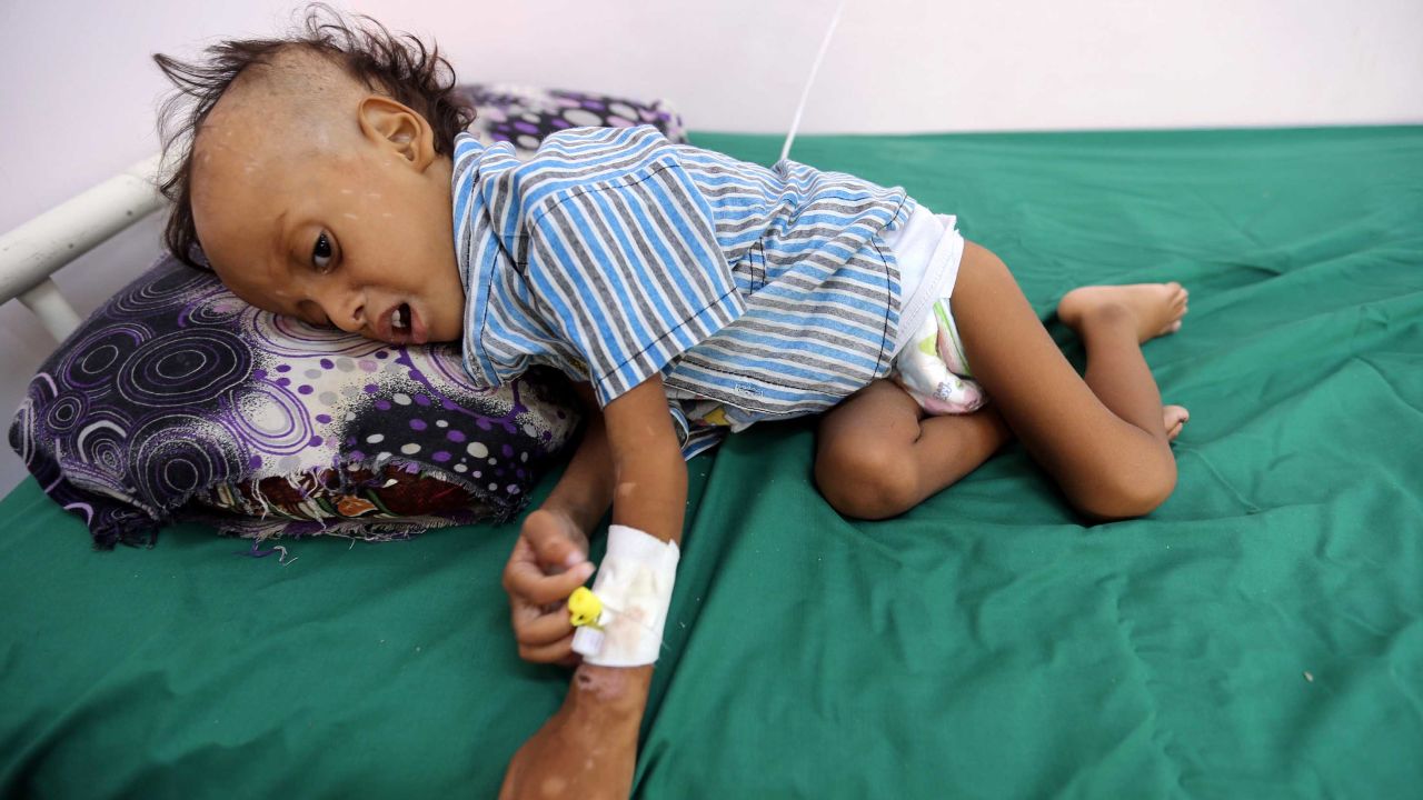 Jibril Mohammed Ali al-Hakami, 2, receiving treatment for malnutrition at the al-Thawra hospital in Hodeidah, Yemen, on Saturday.