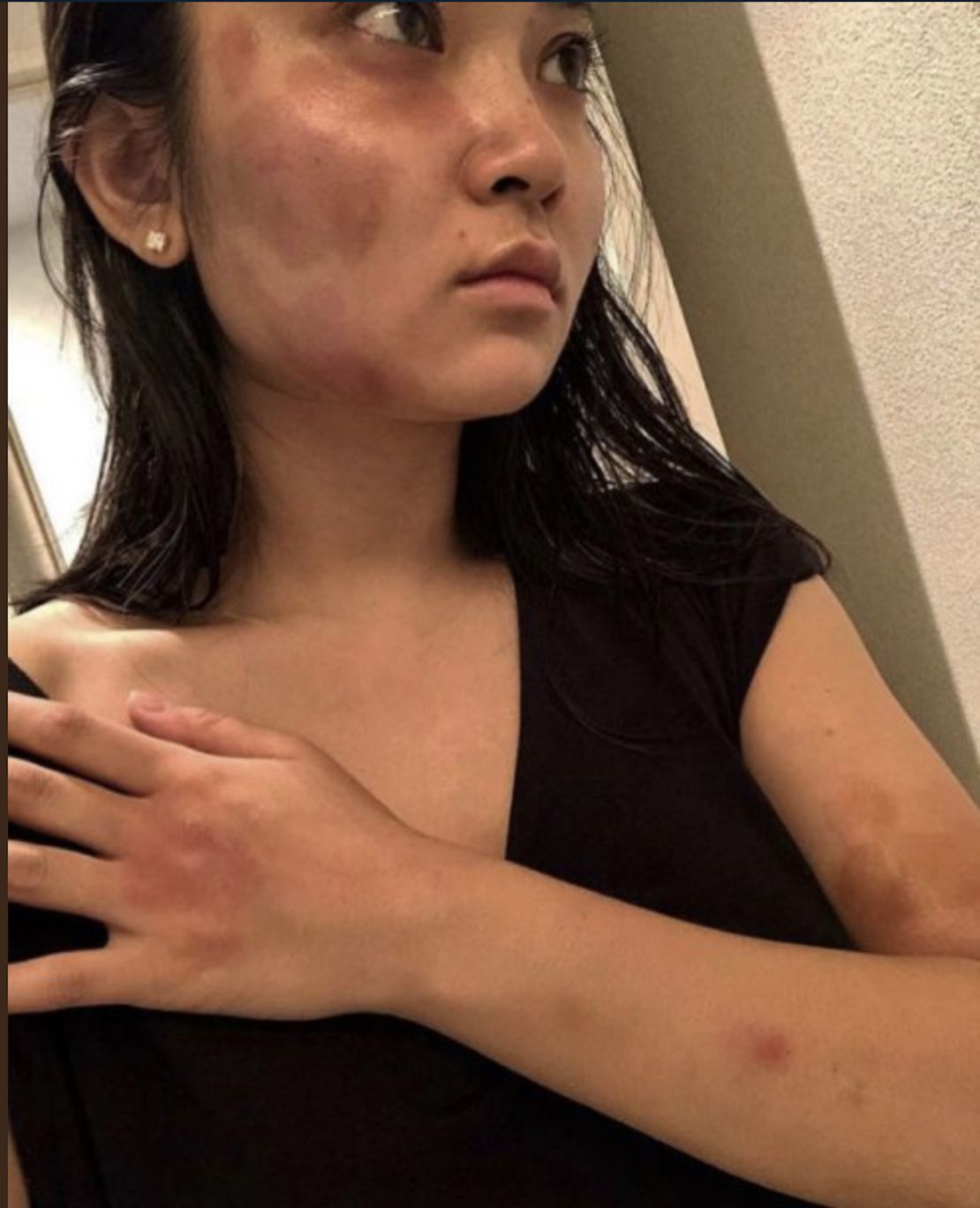 An image from Haruka Nakaura's Instagram account showing bruises on her face.