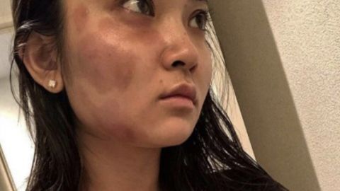 An image from Haruka Nakaura's Instagram account showing bruises on her face.