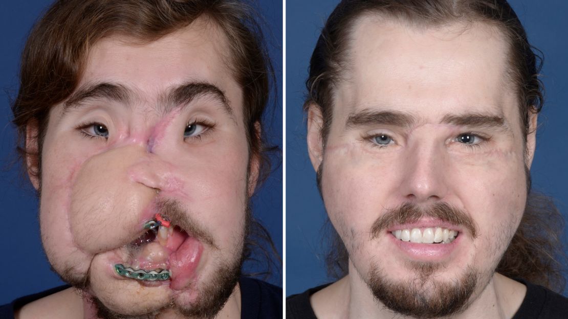 Cameron Underwood before his face transplant and nearly 11 months after the surgery.