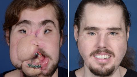 Cameron Underwood before his face transplant and nearly 11 months after the surgery.
