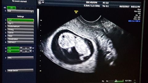 A sonogram shows the baby developing normally within the transplanted uterus.