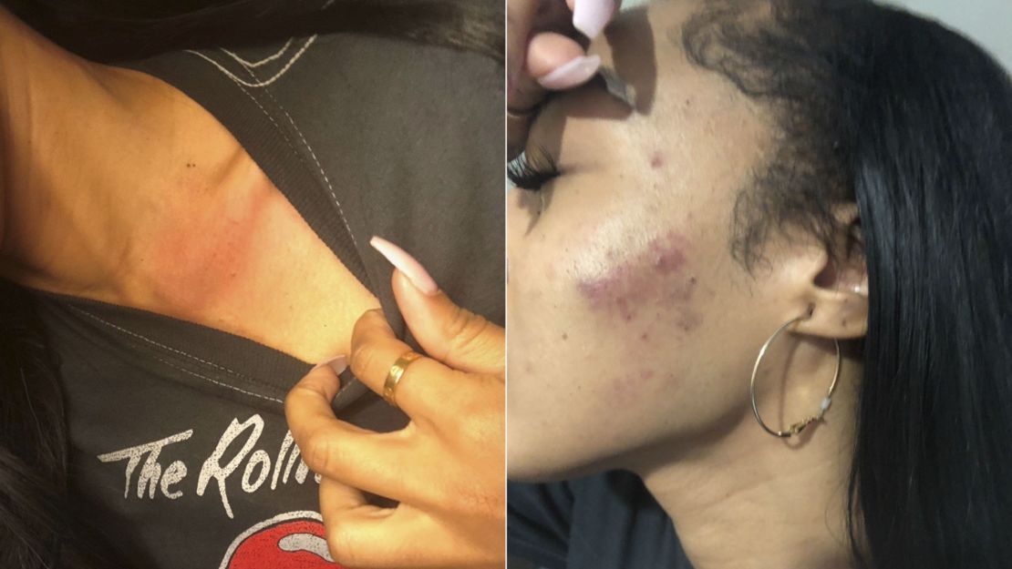 Attorney Adante Pointer releases photos of injuries allegedly sustained by his client Elissa Ennis during a domestic violence incident with former 49er Reuben Foster.