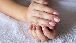 Eczema on the hands . Skin disease; Shutterstock ID 722598496; Job: CNNie Design Website