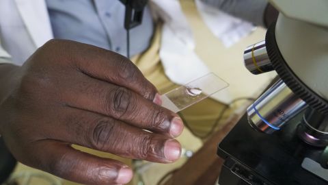 A lab technician at Kiruddu General Hospital examines a microscope slide for malaria.