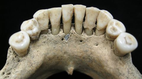 Although it's hard to spot, researchers found flecks of lapis lazuli pigment, called ultramarine, in the dental plaque on the lower jaw of a medieval woman.