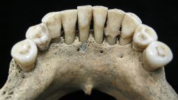 Lapis lazuli pigment entrapped within the dental calculus on the lower jaw of a medieval woman.