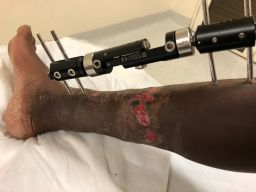 Gwala suffered the horrific chainsaw attack in March 2018.