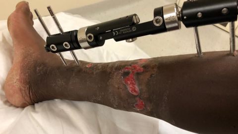 Gwala suffered the horrific chainsaw attack in March 2018.