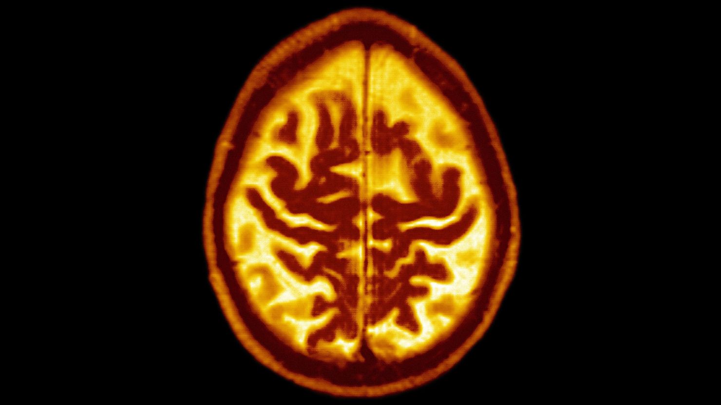 Intensive blood pressure lowering can have a measurable impact on mild cognitive impairment, a precursor of dementia.