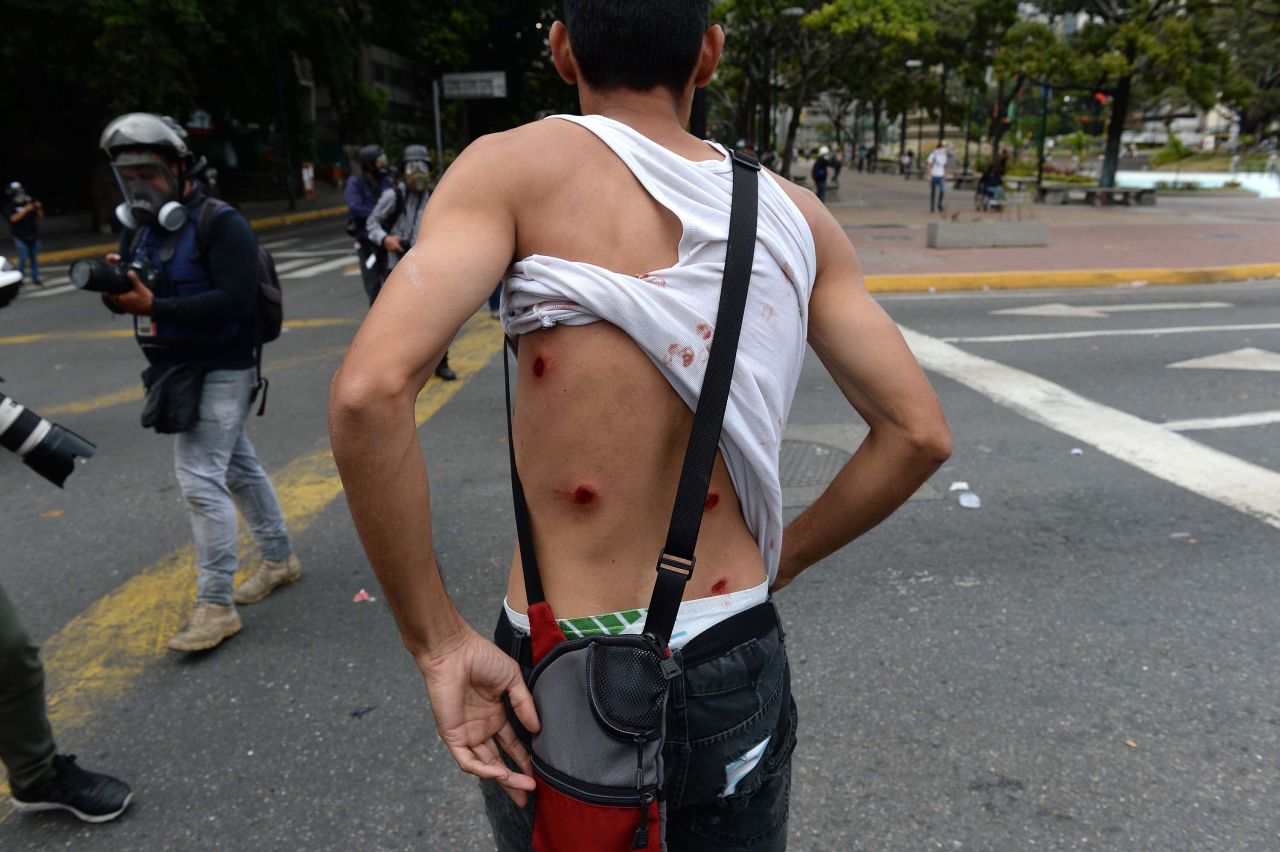 A wounded protester shows his back as riot police clashed with opposition demonstrators in Caracas on January 23.