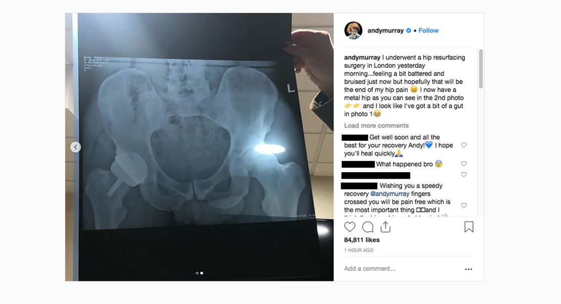 Murray also posted a photo of his metal hip on Instagram.