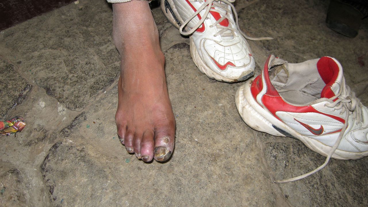 The second stage of frostbite can appear as white or waxy, with numbness to feeling.