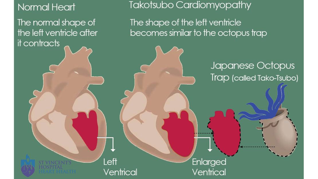 An illustration of takotsubo cardiomyopathy, also known as broken heart syndrome.