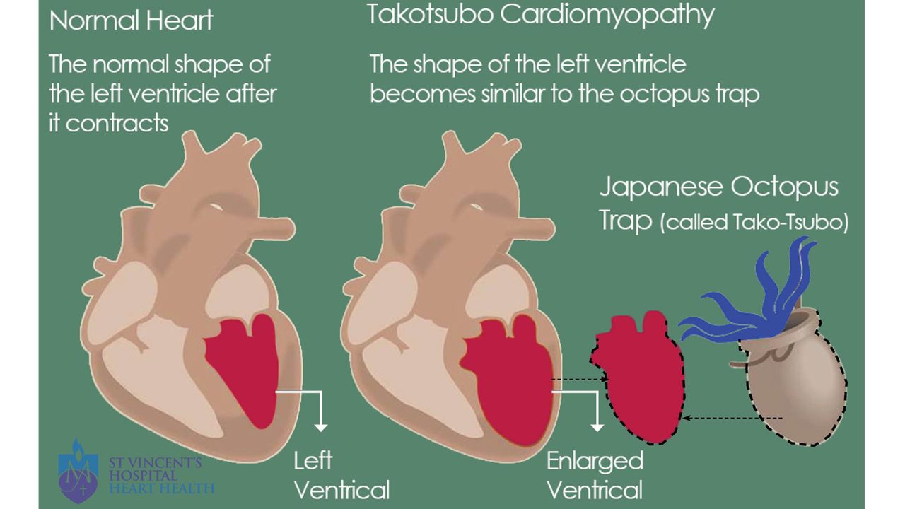 20190209-Takotsubo_Cardiomyopathy_final_image