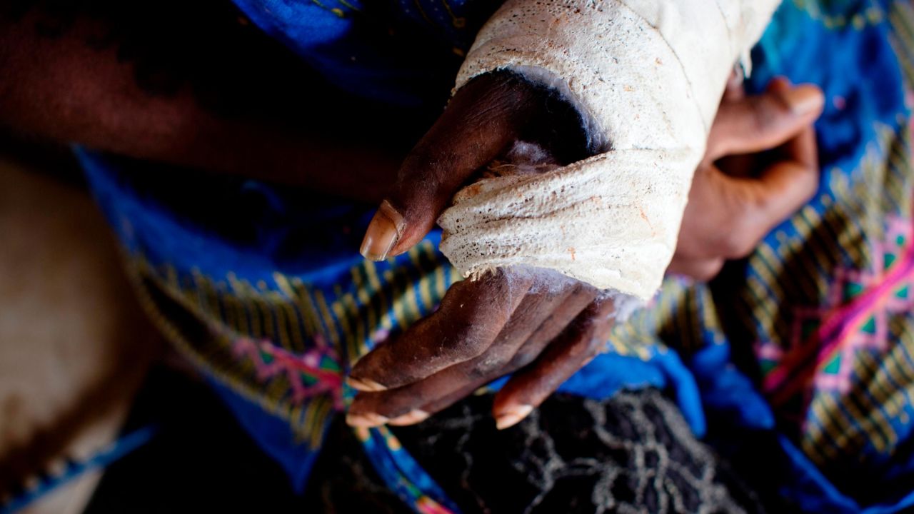 A woman, whose says her husband cut her arm with a large metal knife, holds her bandaged hand at a women's centre in Wewek East Sipek, Papua New Guinea, on March 4, 2019. 