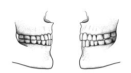The difference between a Paleolithic edge-to-edge bite (left) and a modern overbite/overjet bite (right). 
