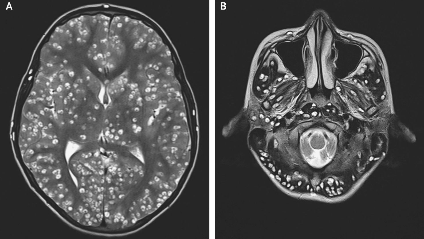 Damage-causing cysts were seen on MRI scans of the patient's cerebral cortex and brain stem.