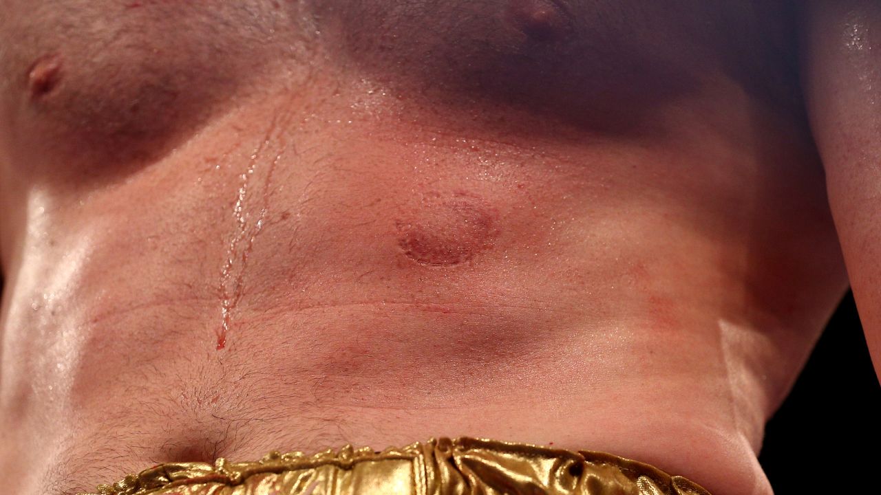 Price's body clearly shows the bite mark.