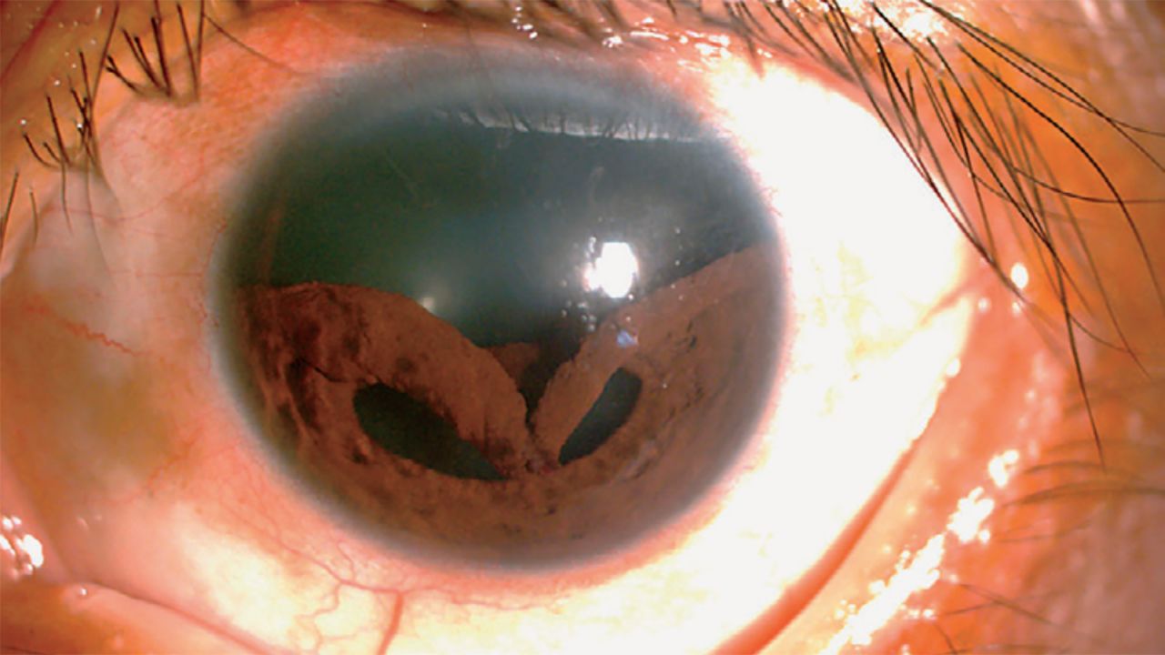 A National Taiwan University Hospital patient arrived at the ophthalmology clinic with a uniquely deformed iris.