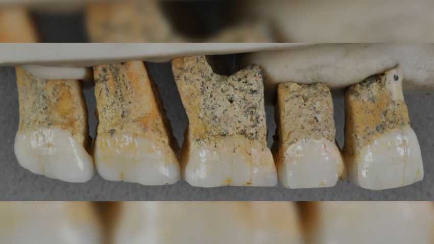 Right Upper teeth of the individual CCH6, the type specimen of the new species Homo luzonensis. From left to right: two premolars and 3 molars, in lingual view.

Credit: Callao Cave Archaeology Project . Email address for the copyright holder: florent.detroit@mnhn.fr