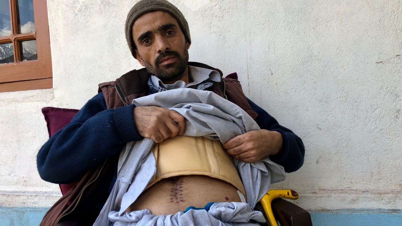 Mohammad Riyad shows the scars he received after shrapnel split open his abdomen.