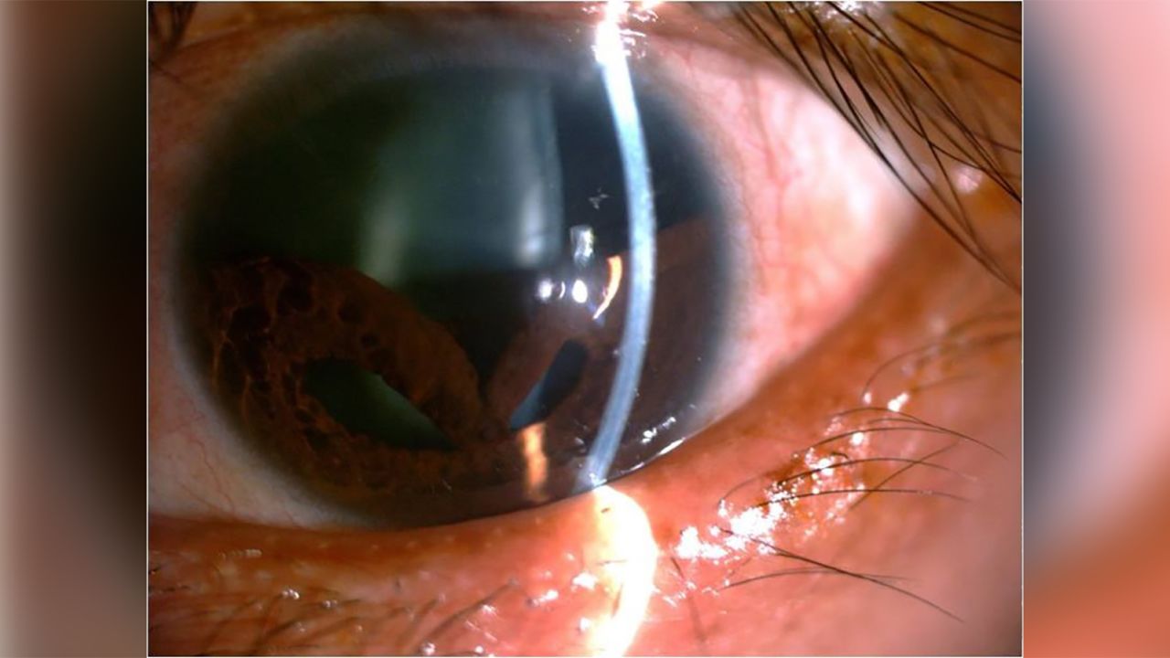 Another view of the patient's iris.