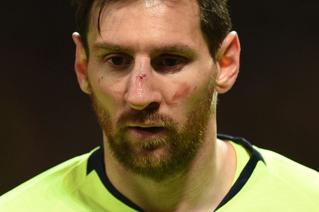 Lionel Messi pictured bruised and bloodied in Barcelona's Champions League quarterfinal match against Manchester United.