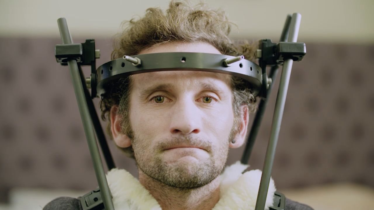 After breaking his neck, Tim Don was fitted with a halo in hopes of having a quicker recovery.