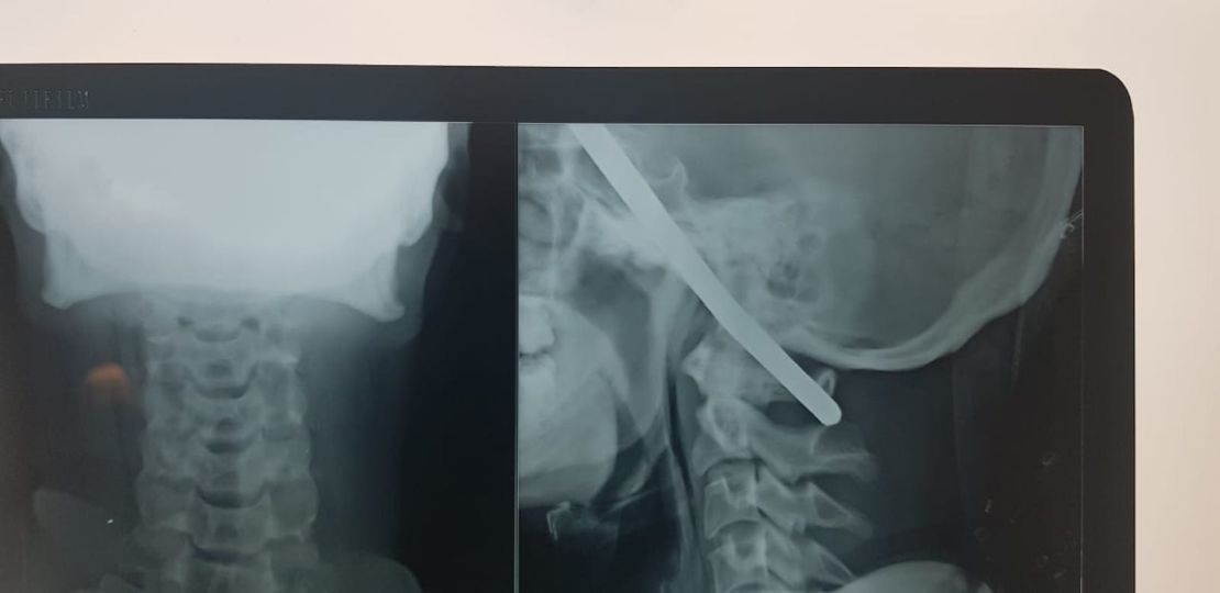 The iron rod entered the man's right temporal region and exited through the left frontal lobe.