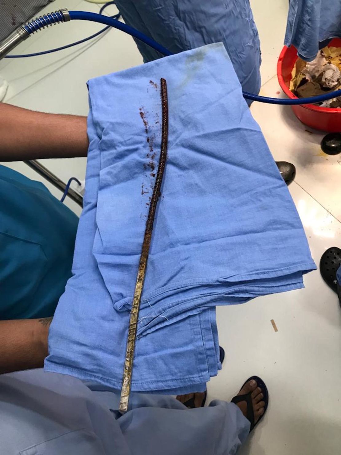 A team of six doctors at the Nagpur hospital extracted the rod without rupturing any vessels.