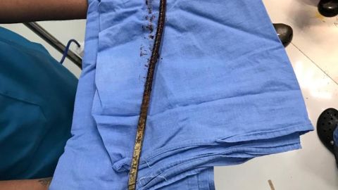 A team of six doctors at the Nagpur hospital extracted the rod without rupturing any vessels.