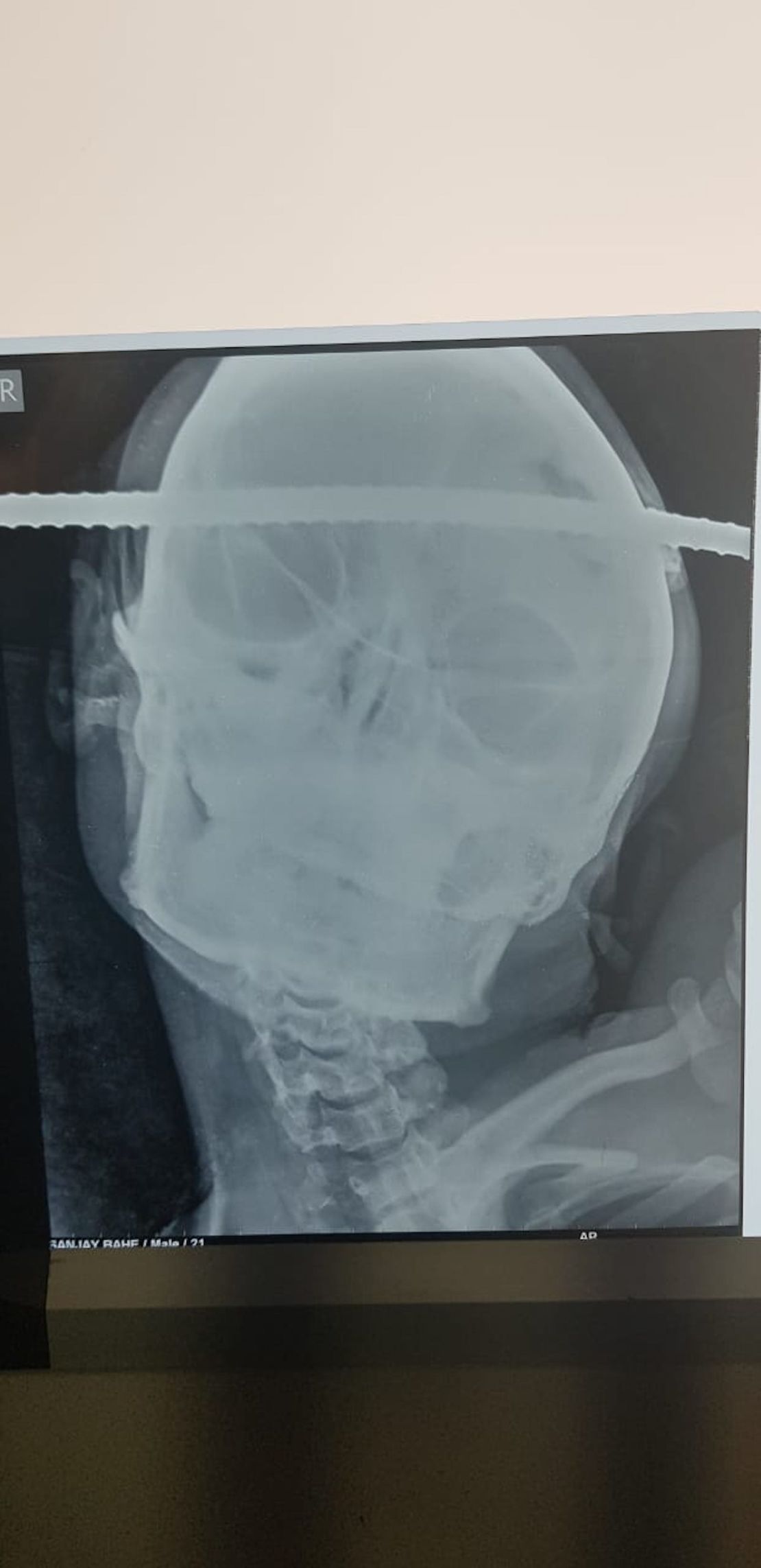 The man suffered no brain trauma after the rod went straight through his skull. 