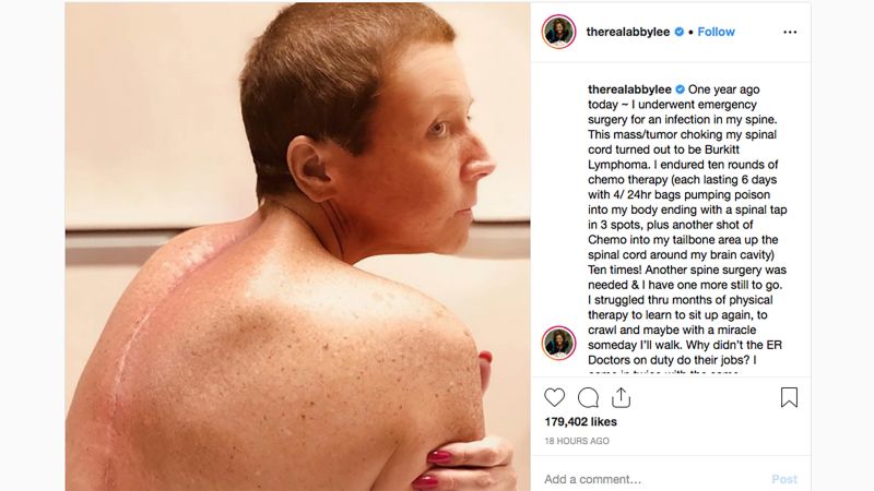 Abby Lee Miller Shows Off Scars, Removes Wig During Cancer: Pics