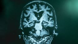 Alzheimer MRI
