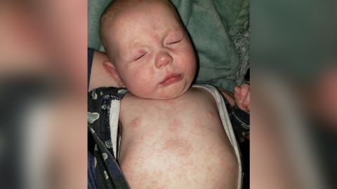Walter Blum was 5 months old when he developed measles. 
