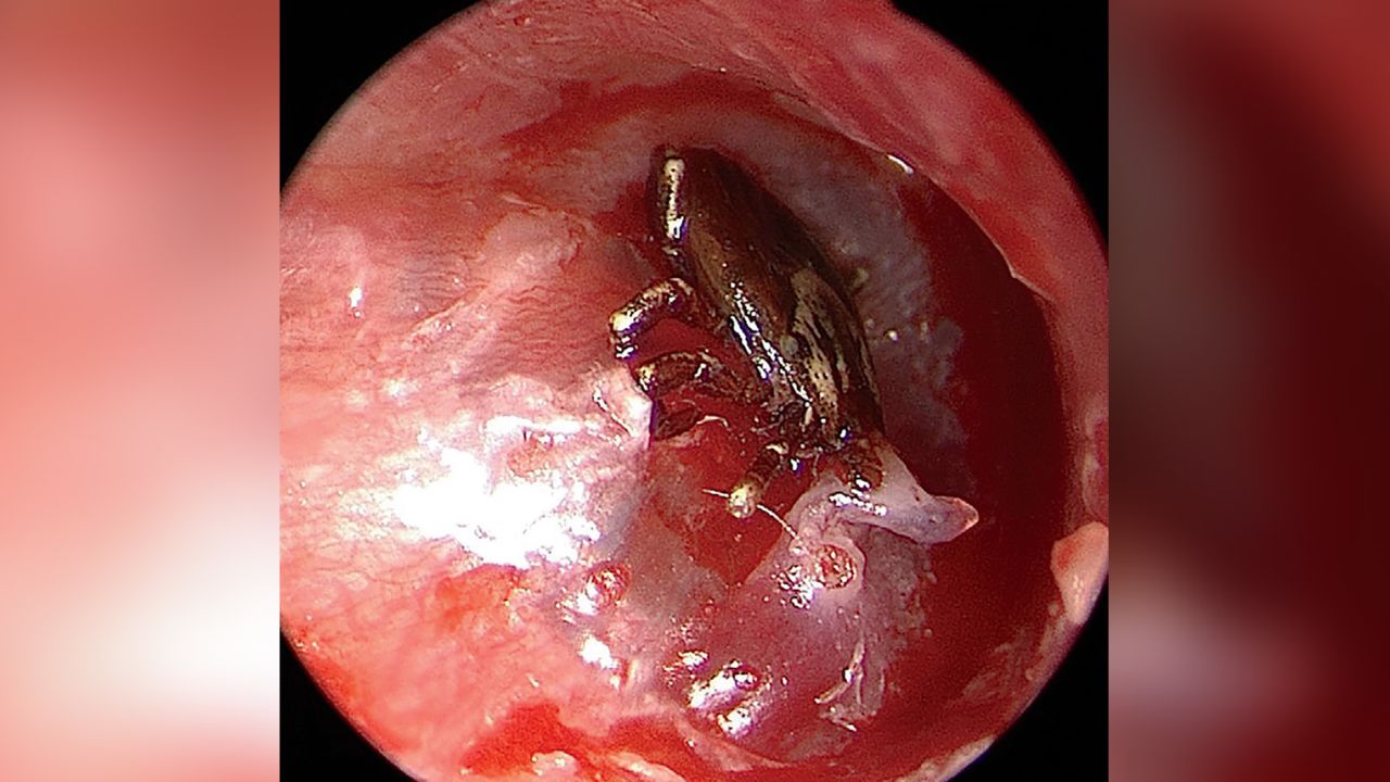 It was unusual, but a tick had embedded in a boy's right eardrum.