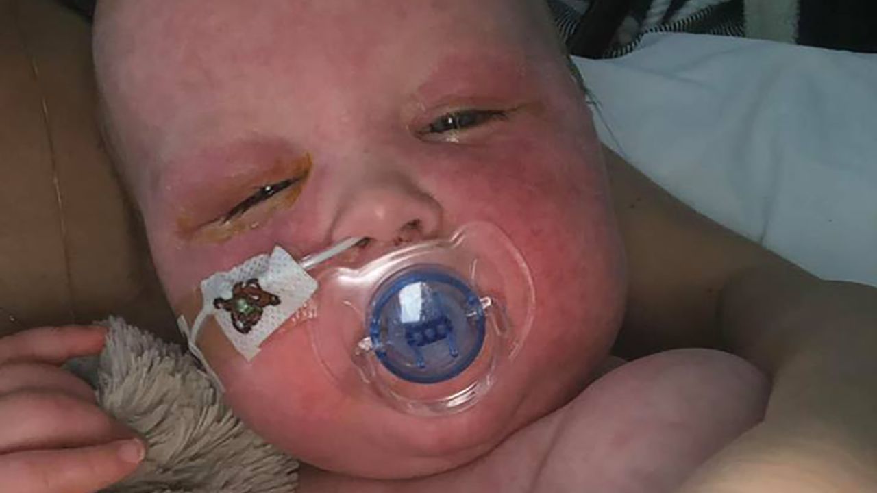 Alba received doses of vitamin A so she wouldn't go blind, a complication of measles.