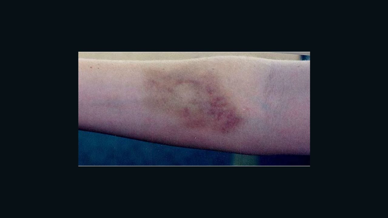 A photo of Harmony Allen's arm three days after her rape on August 28, 2000, at United Regional Health Care System in Wichita Falls, Texas.