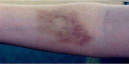 A photo of Harmony Allen's arm three days after her rape on August 28, 2000, at United Regional Health Care System in Wichita Falls, Texas.