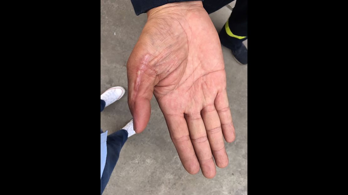 Pinyo Pookpinyo had to undergo surgery to remove dead tissue after being bitten on this thumb.