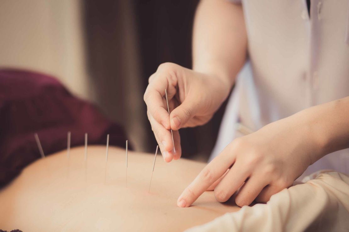 A physiotherapist performs acupuncture on the back of a patient.