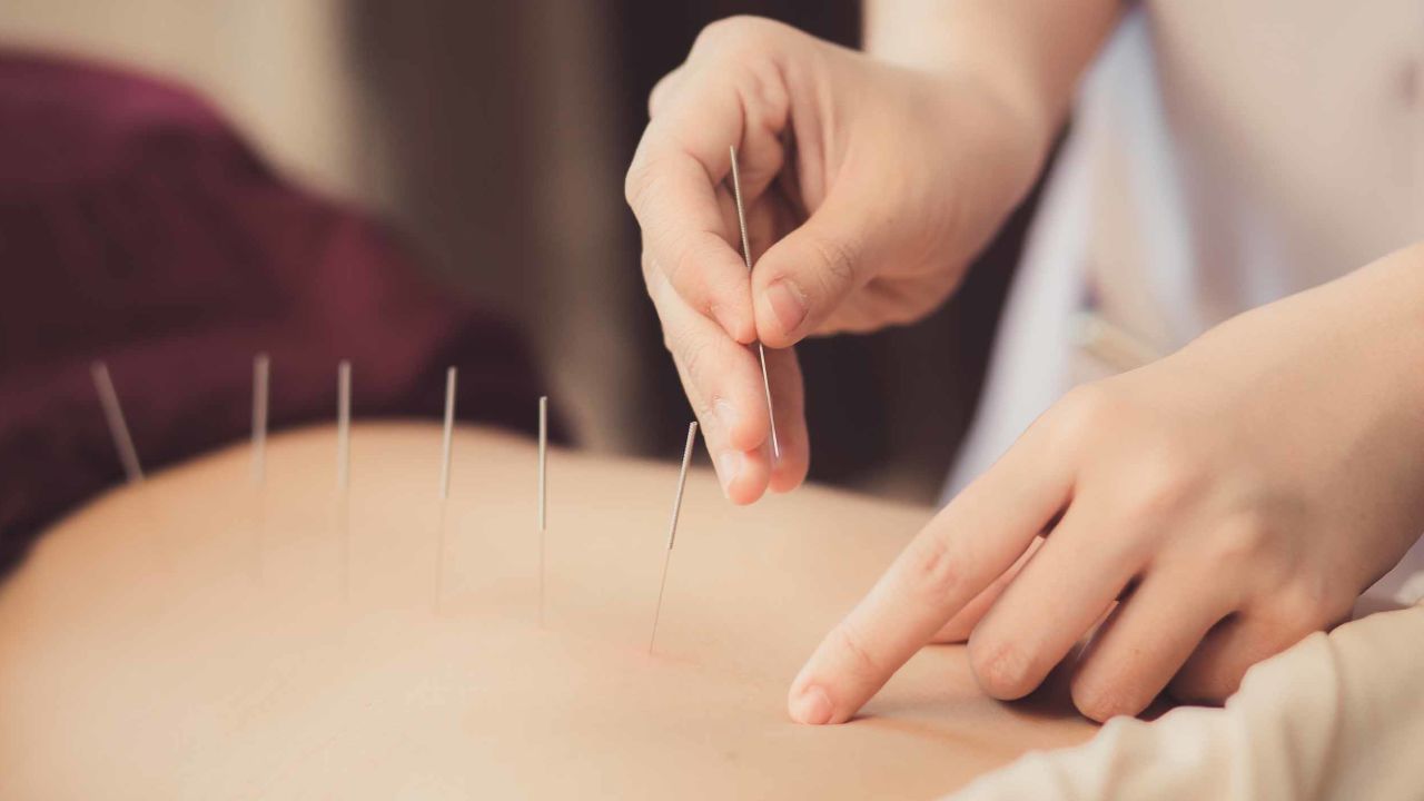 A physiotherapist performs acupuncture on the back of a patient.