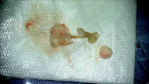 A tapeworm was found inside Rachel Palma's brain.