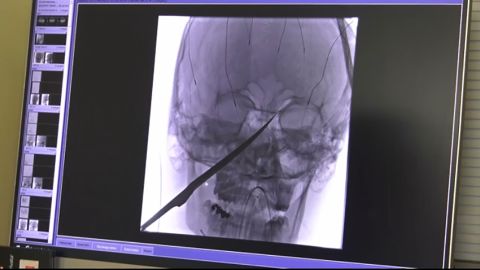 An X-ray image of Eli Gregg's injury shows where the knife went into his face.