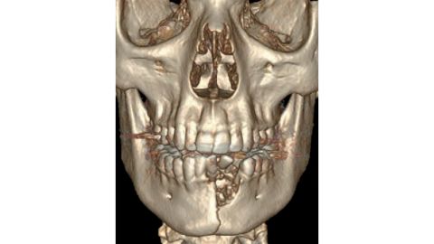 A CT scan of the 17-year-old boy, featuring his shattered jaw and displaced teeth.
