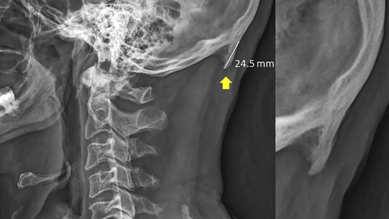 An X-ray of a 58-year-old male participant from the study.