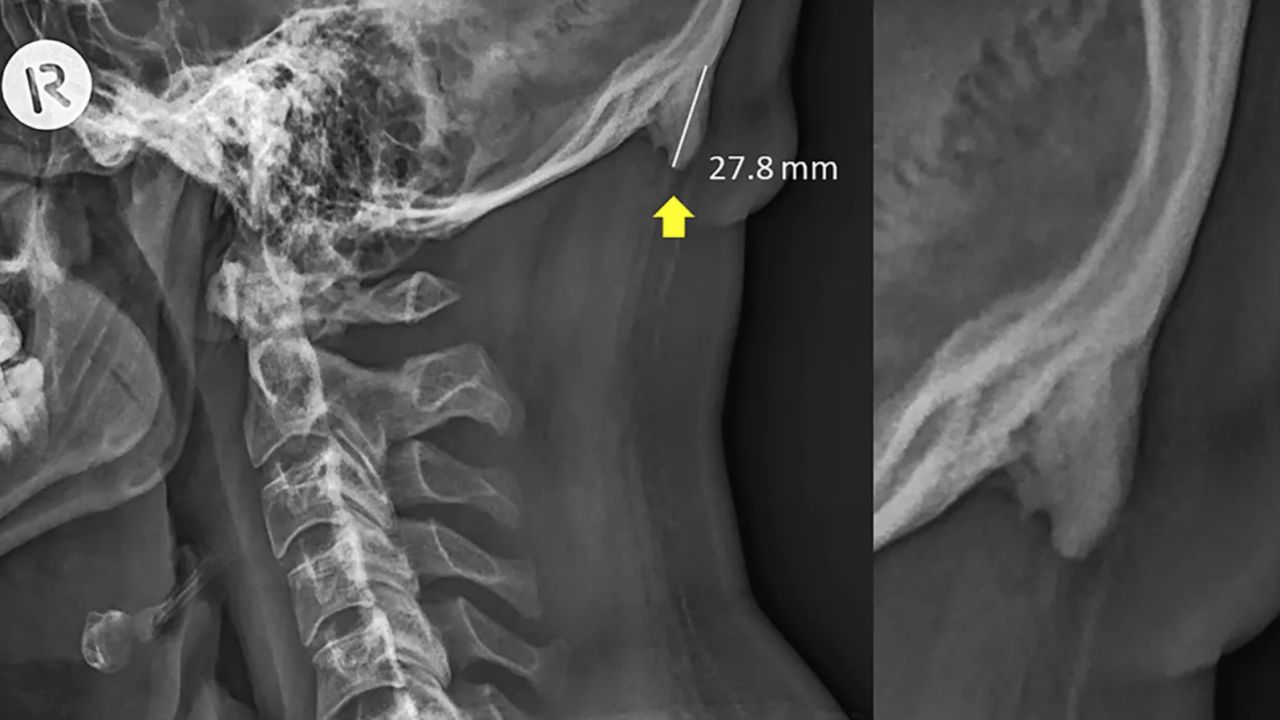 An X-ray of a 28-year-old male participant from the study.