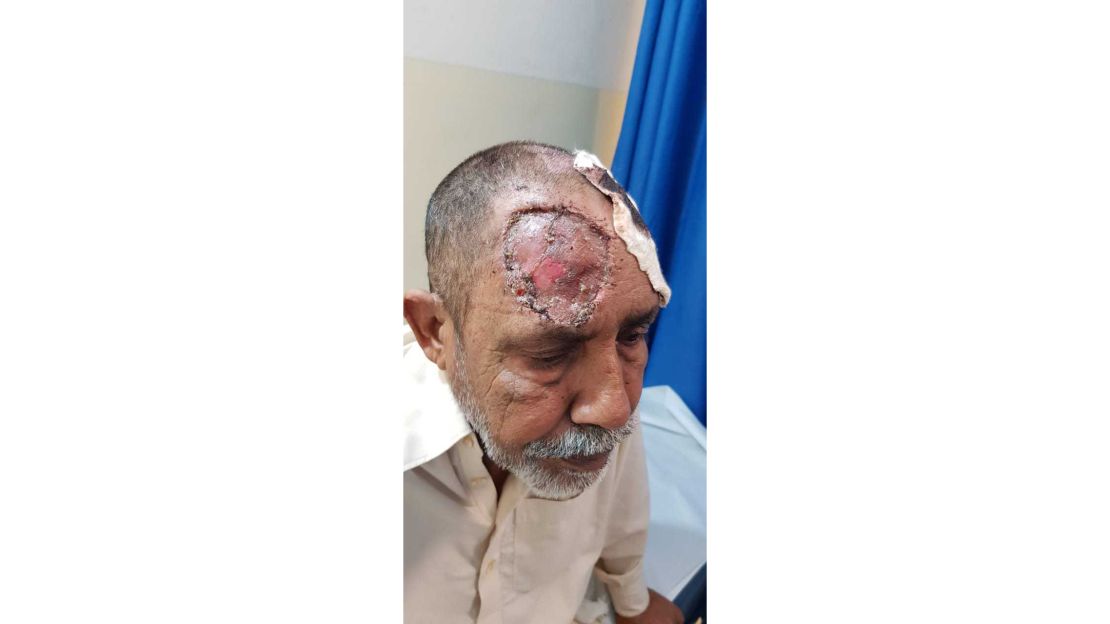 Patient A: First Recipient of Skin Transplant.