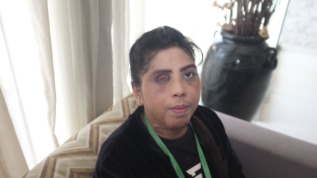 Josephine Barkat was only four years old when she was attacked with acid. She lost her eye and was burned from the neck down.